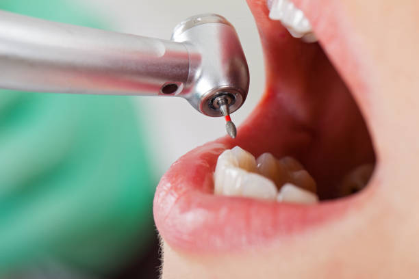 Best Emergency Wisdom Teeth Removal in Chetek, WI